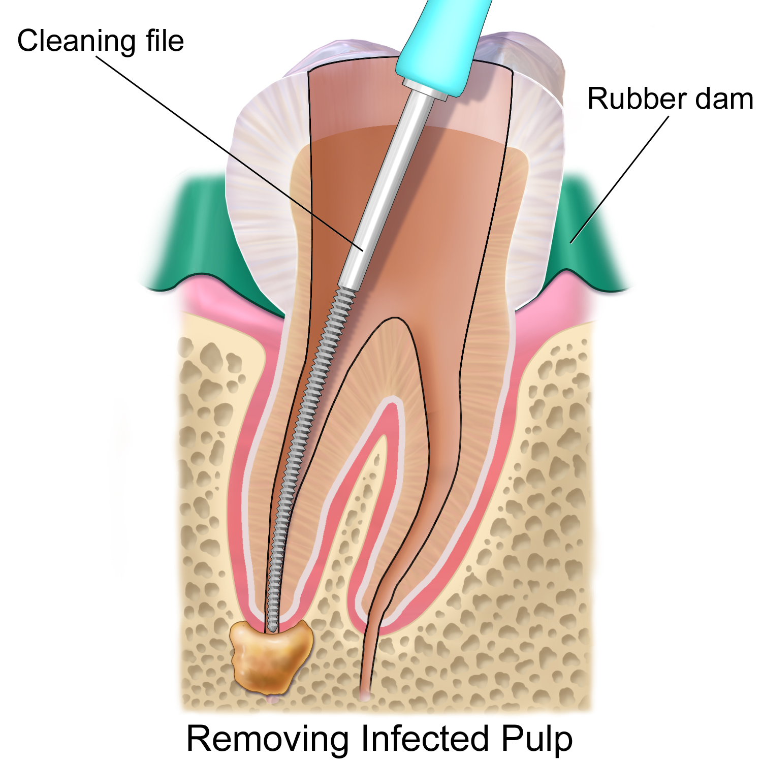 Root Canal Dentist in Mississauga