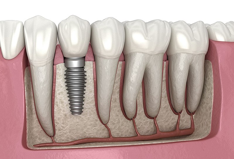 dental-implants-img2